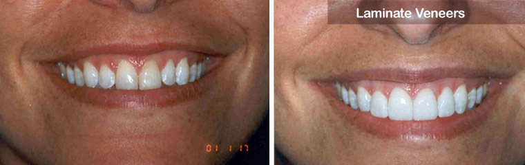 Laminate Veneers - Before and After