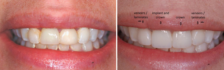 Laminate Veneers - Before and After