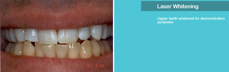 Laser Whitening - Upper Teeth Only
