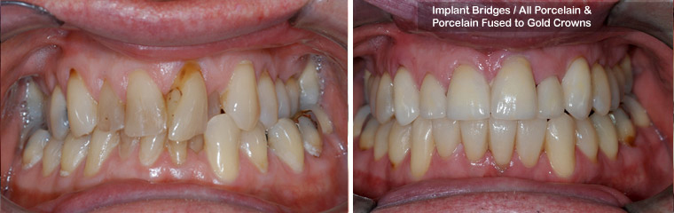 Implant Bridges/All Porcelain and Porcelain Fused to Gold Crowns - Before and After