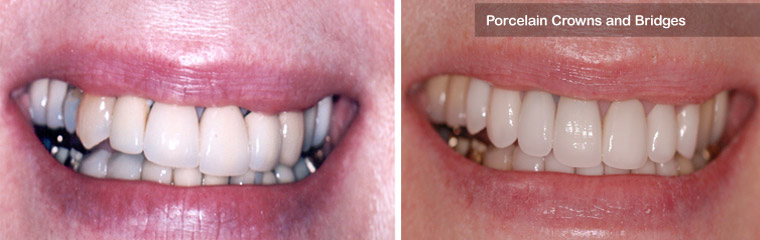Porcelain Crowns and Bridges - Before and After