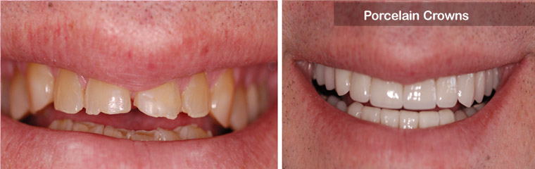 Porcelain Crowns - Before and After