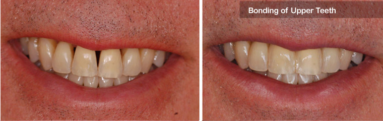 Bonding of Upper Teeth - Before and After